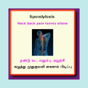 Spondylosis Spondylitis