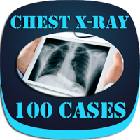Interpret Chest X-Ray With 100 Cases