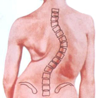 Korea University Scoliosis